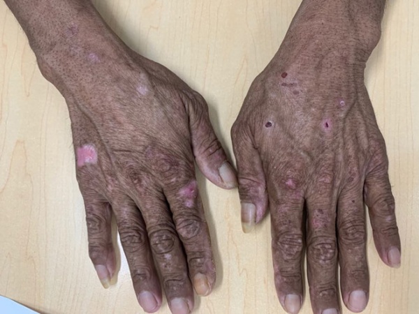 Hình ảnh da tay bị nhiễm độc kim loại nặng 