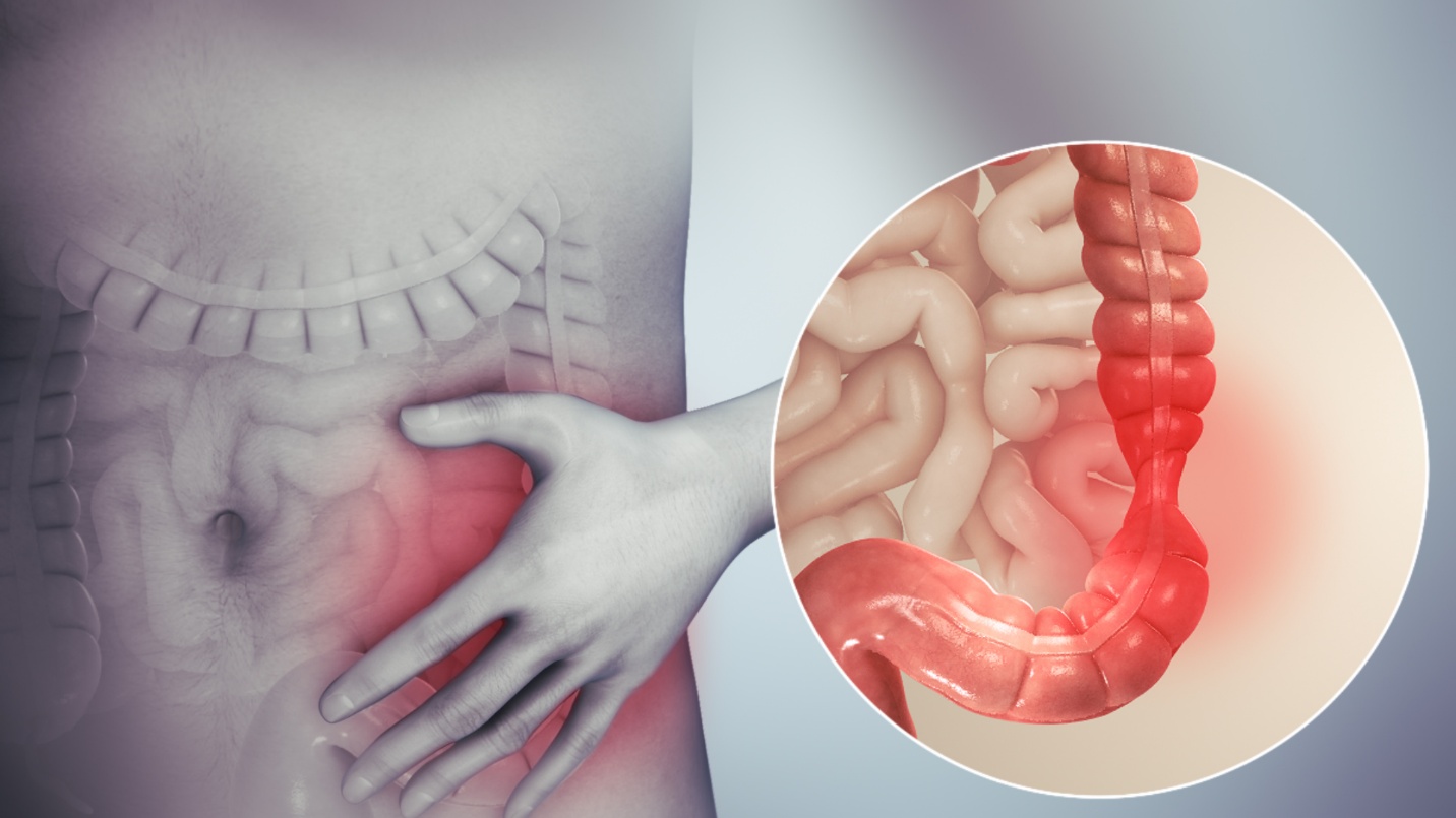 Hội chứng ruột kích thích có thể gây ra tình trạng tiêu chảy 