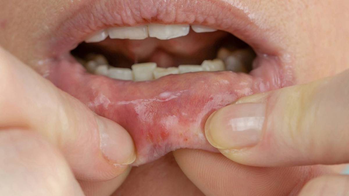 Hay bị nhiệt miệng là dấu hiệu của bệnh gì? Cảnh báo nguy cơ 4 Nhiệt miệng có thể do thiếu vitamin và khoáng chất trong cơ thể