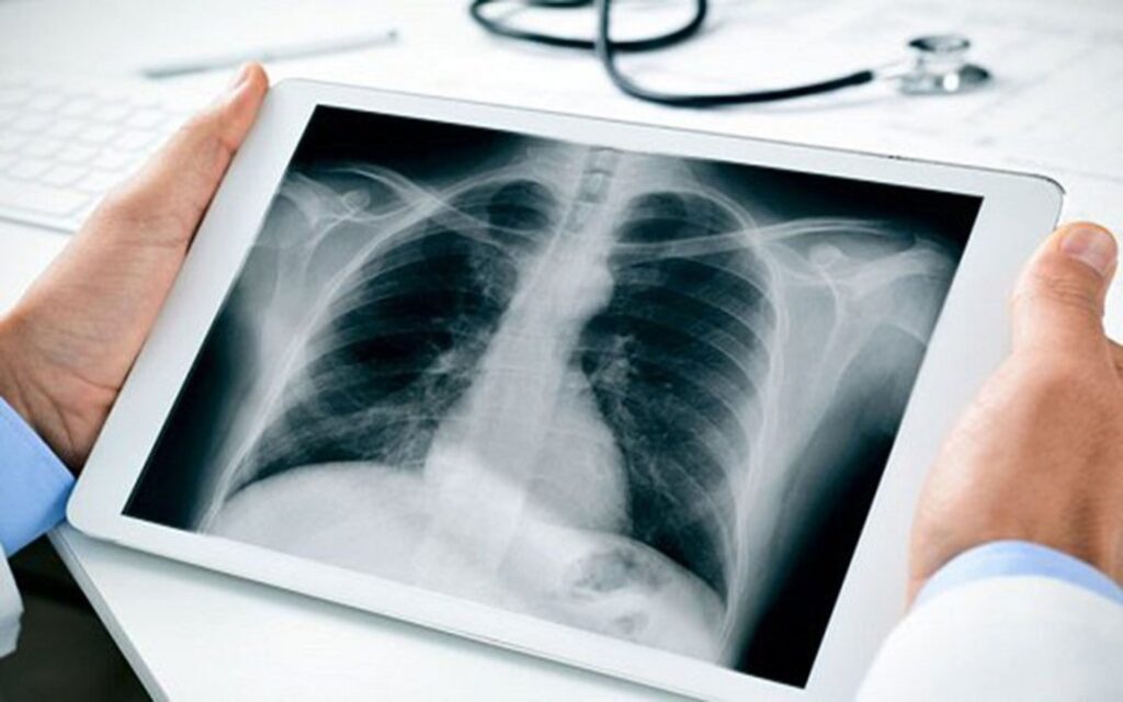 Chụp X-quang tiêu hóa trên hàng loạt có thể chẩn đoán viêm loét dạ dày