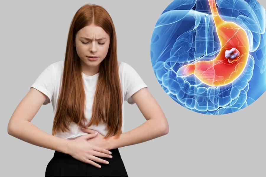 Ung thư dạ dày là hiện tượng tổn thương nặng xuất hiện trong dạ dày Ung thư dạ dày là hiện tượng tổn thương nặng xuất hiện trong dạ dày