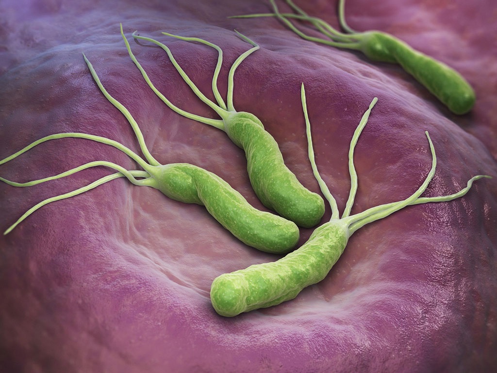 Nhiễm vi khuẩn Helicobacter Pylori là một trong các nguyên nhân phổ biến gây viêm dạ dày