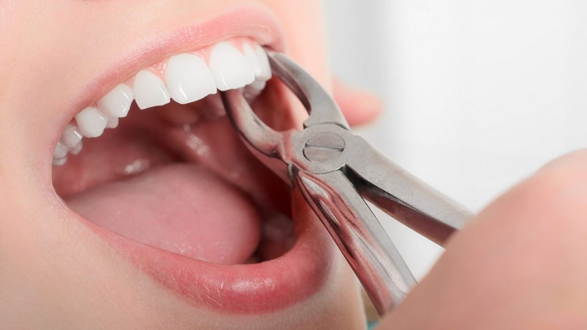 Nên nhổ răng tại các nha khoa uy tín để đảm bảo sức khỏe