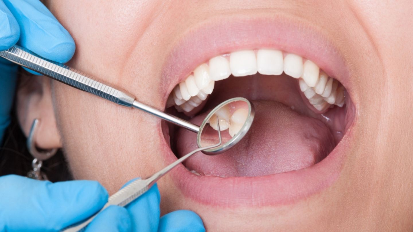 Sử dụng chất tạo ngọt nhân tạo là cách an toàn và hiệu quả để bảo vệ răng miệng