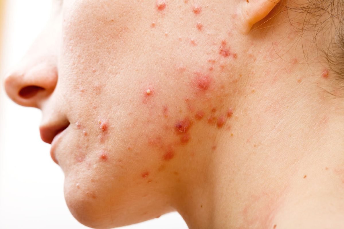 Dư Collagen có thể gây nổi mụn Dư Collagen có thể gây nổi mụn
