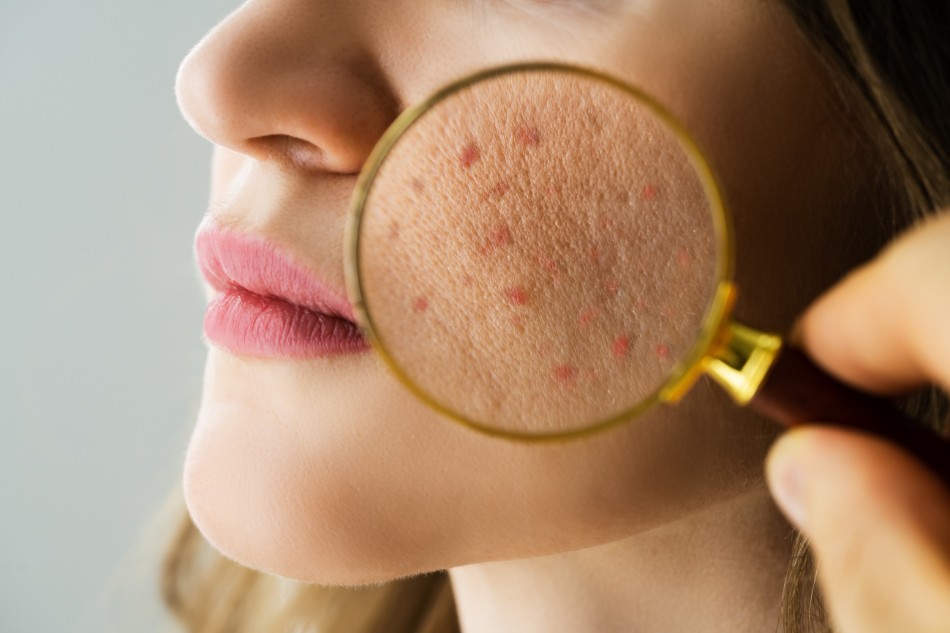 Cần thải độc da khi có các dấu hiệu như khô, mụn, kích ứng...