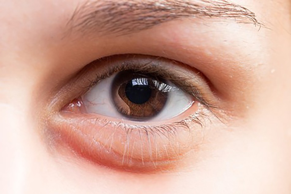 Da vùng mắt sưng, thâm quầng và tăng tiết dầu ở mặt là dấu hiệu da đang thải độc