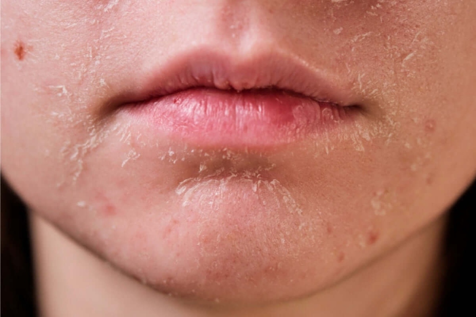 Dấu hiệu da mặt đang thải độc thông qua biểu hiện khô và sần sùi